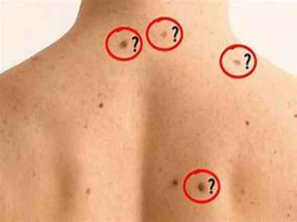 Nốt ruồi mọc tại bộ vị của lưng