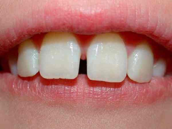Răng cửa nhỏ, hơi thưa – Người sống nội tâm, nhạy cảm