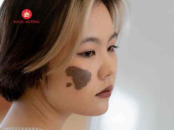 Góc nhìn khoa học – Vết bớt chỉ là sinh học?