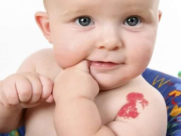Vết bớt đỏ có ý nghĩa gì?