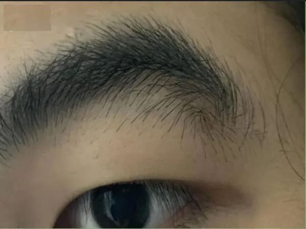 Xoáy ở lông mày là gì
