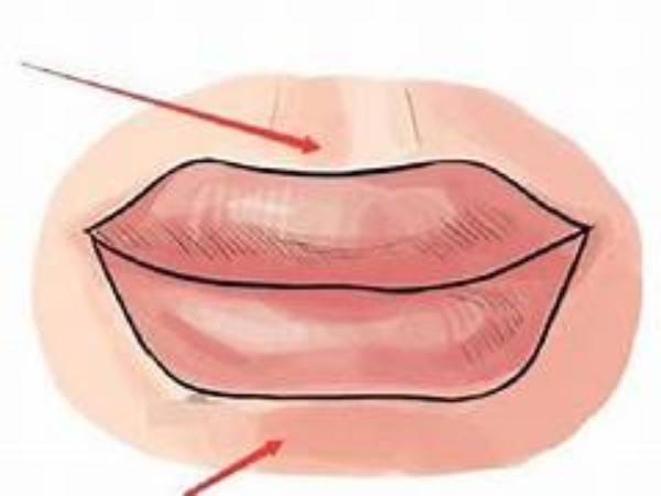 Tướng môi cá chép xấu