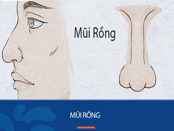 Người tướng mũi rồng thường gặp may mắn trong cuộc sống