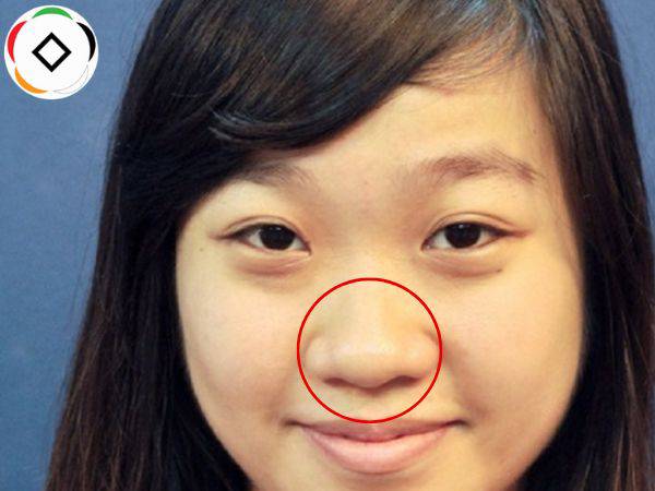 Mũi to là như thế nào?