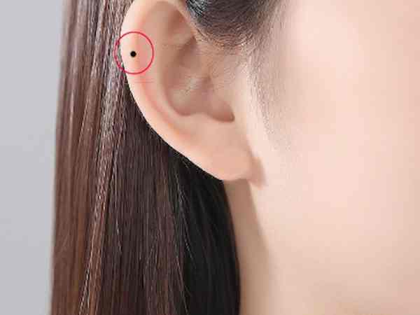 Có nên tẩy nốt ruồi ở vành tai hay không?