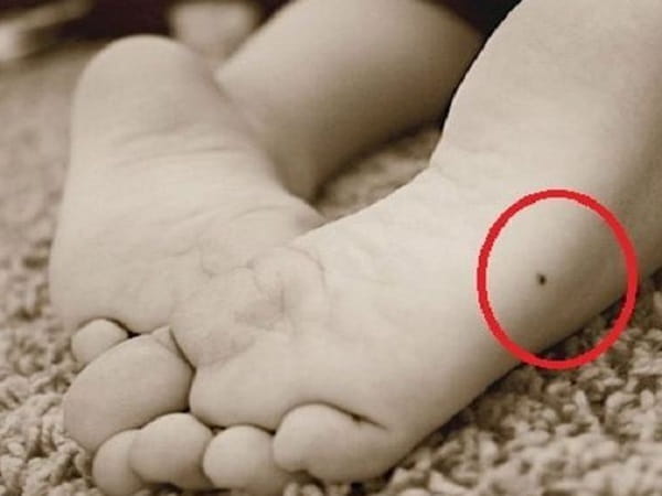 Ý nghĩa nốt ruồi ở mép bàn chân trái nam và nữ